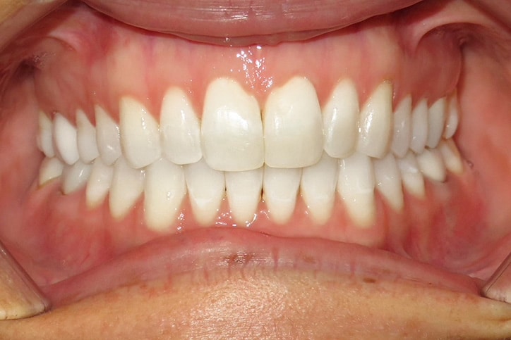 A photo of a set of aligned teeth from the front.