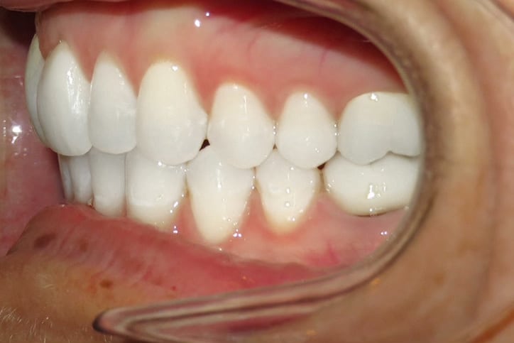 A photo of a set of aligned teeth from the left side.