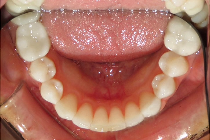 A photo of a set of bottom teeth in a dental mirror.