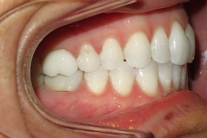 A photo of a set of aligned teeth from the right side.