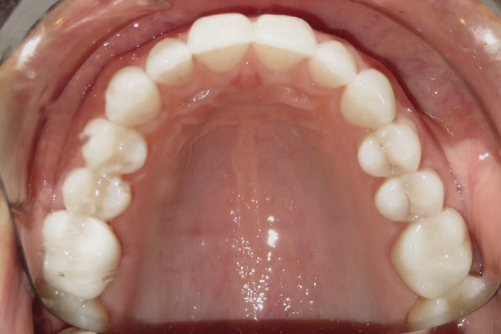 A photo of a set of upper teeth in a mirror.