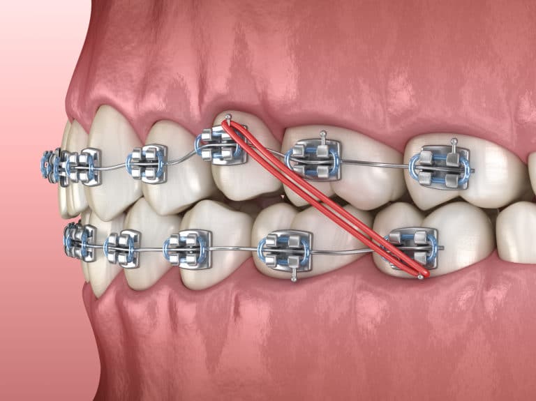 a graphic of a teeth model with braces and a red elastic band
