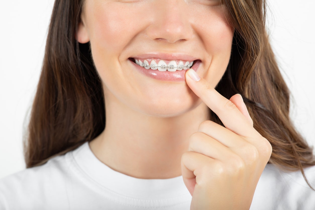 Types Of Braces Risinger Orthodontics 