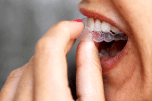 Invisalign