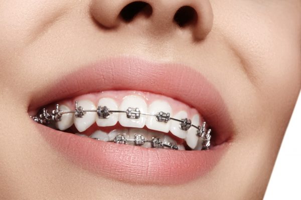 Close up of a woman's mouth, smiling with metal braces